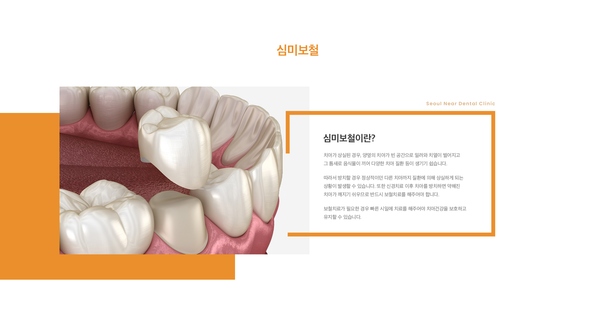 심미 보철