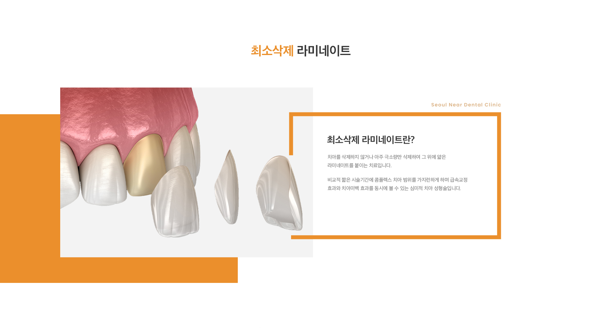 최소삭제 라미네이트