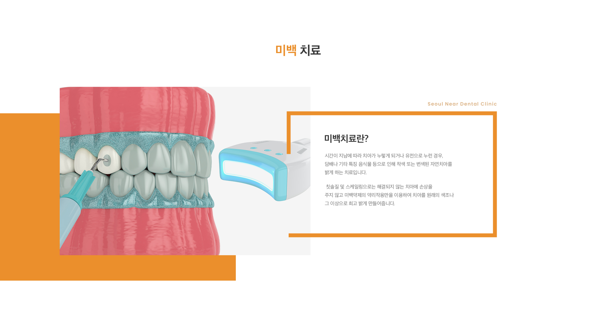 미백치료