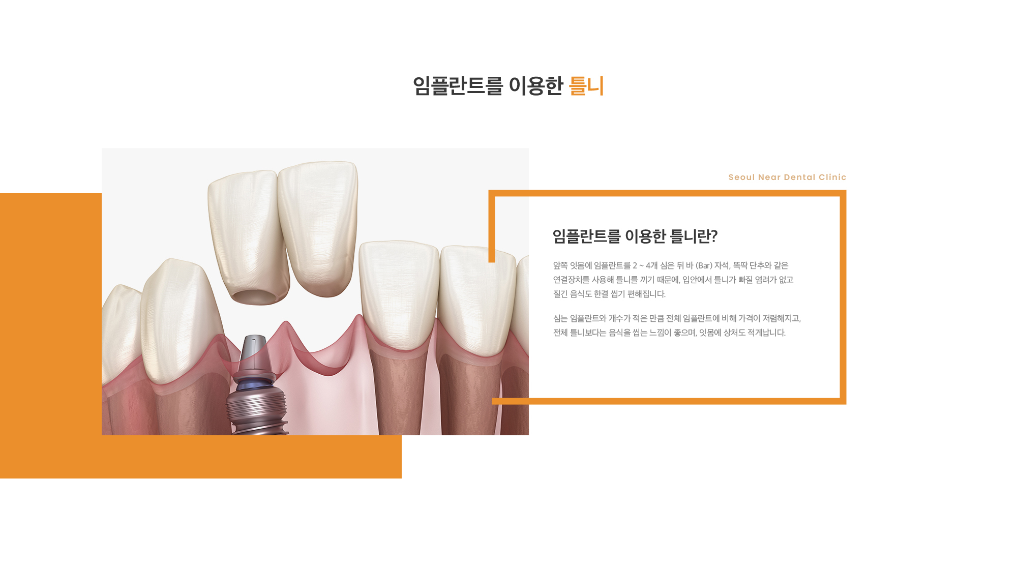 임플란트를 이용한 틀니란? 앞쪽 잇몸에 임플란트를 2 ~ 4개 심은 뒤 바 (Bar) 자석, 똑딱 단추와 같은 연결장치를 사용해 틀니를 끼기 때문에, 입안에서 틀니가 빠질 염려가 없고 질긴 음식도 한결 씹기 편해집니다. 심는 임플란트와 개수가 적은 만큼 전체 임플란트에 비해 가격이 저렴해지고, 전체 틀니보다는 음식을 씹는 느낌이 좋으며, 잇몸에 상처도 적게납니다. 