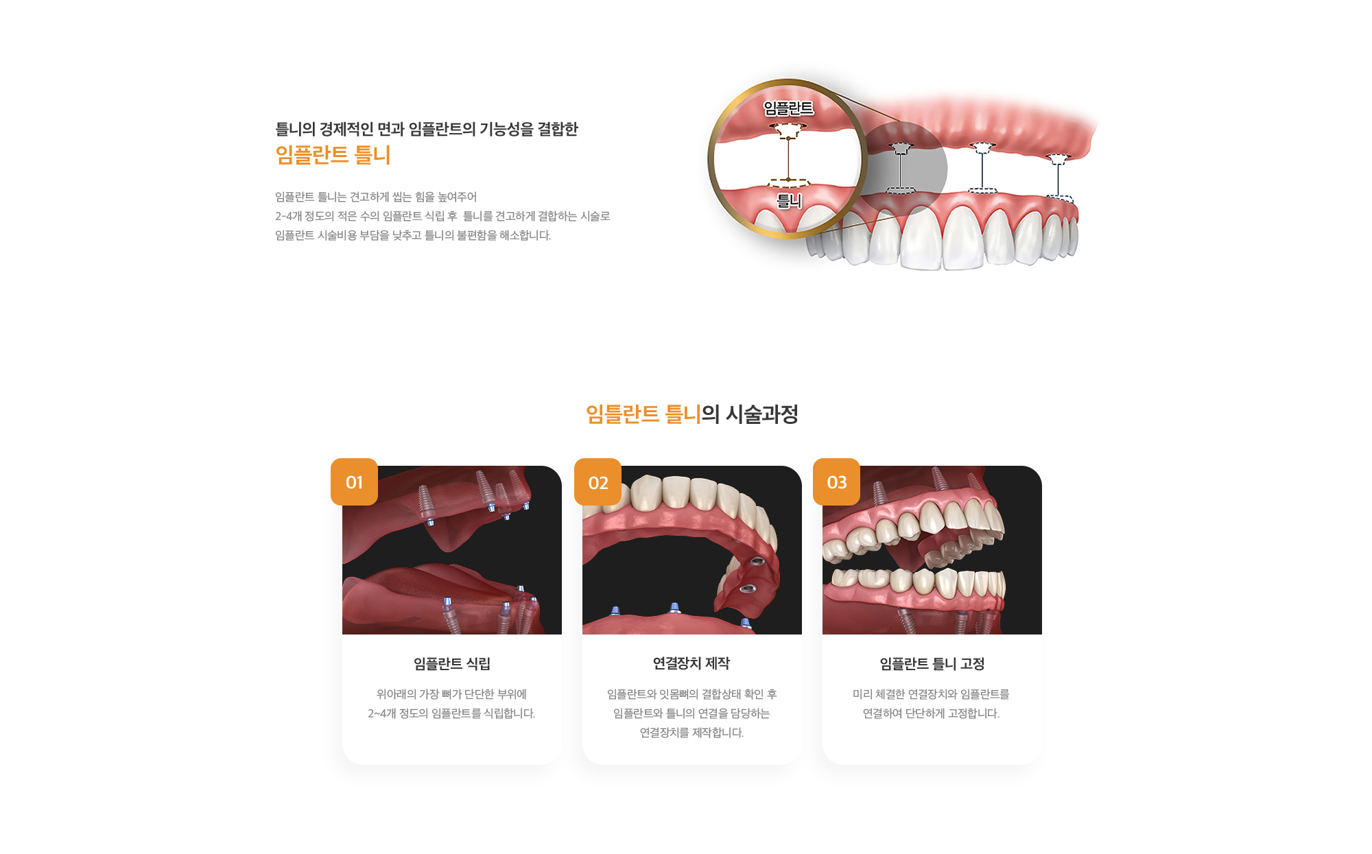 틀니의 경제적인 면과 임플란트의 기능성을 결합한 임플란트 틀니 임플란트 틀니는 견고하게 씹는 힘을 높여주어 2-4개 정도의 적은 수의 임플란트 식립 후  틀니를 견고하게 결합하는 시술로 임플란트 시술비용 부담을 낮추고 틀니의 불편함을 해소합니다.