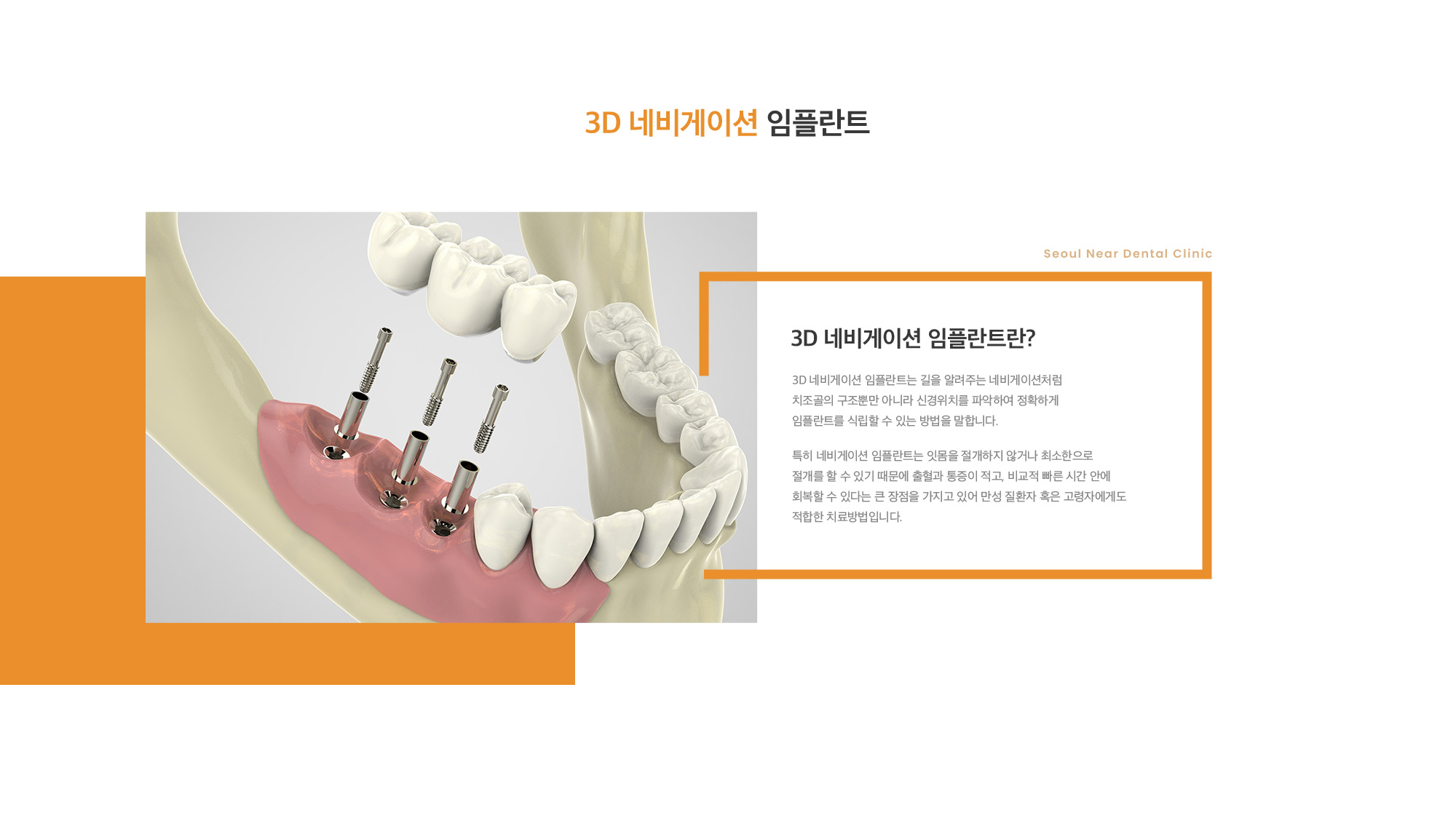 3D 네비게이션 임플란트 3D 네비게이션 임플란트는 길을 알려주는 네비게이션처럼 치조골의 구조뿐만 아니라 신경위치를 파악하여 정확하게 임플란트를 식립할 수 있는 방법을 말합니다. 특히 네비게이션 임플란트는 잇몸을 절개하지 않거나 최소한으로 절개를 할 수 있기 때문에 출혈과 통증이 적고, 비교적 빠른 시간 안에 회복할 수 있다는 큰 장점을 가지고 있어 만성 질환자 혹은 고령자에게도 적합한 치료방법입니다.   