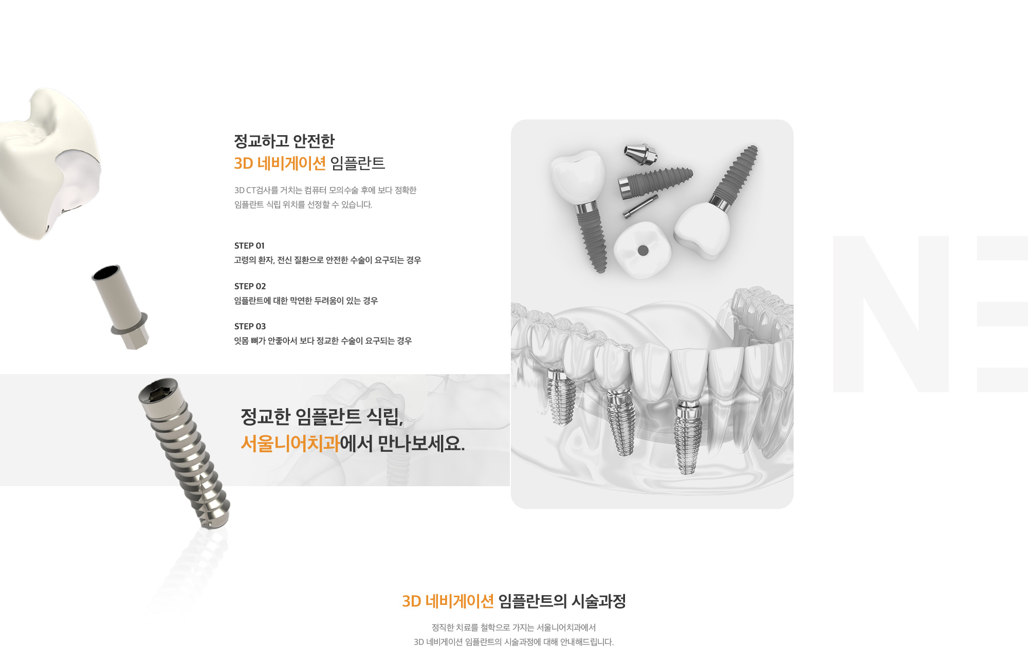 정교하고 안전한 3D 네비게이션 임플란트 : 1. 고령의 환자, 전신 질환으로 안전한 수술이 요구되는 경우, 2. 임플란트에 대한 막연한 두려움이 있는 경우, 3. 잇몸 뼈가 안좋아서 보다 정교한 수술이 요구되는 경우