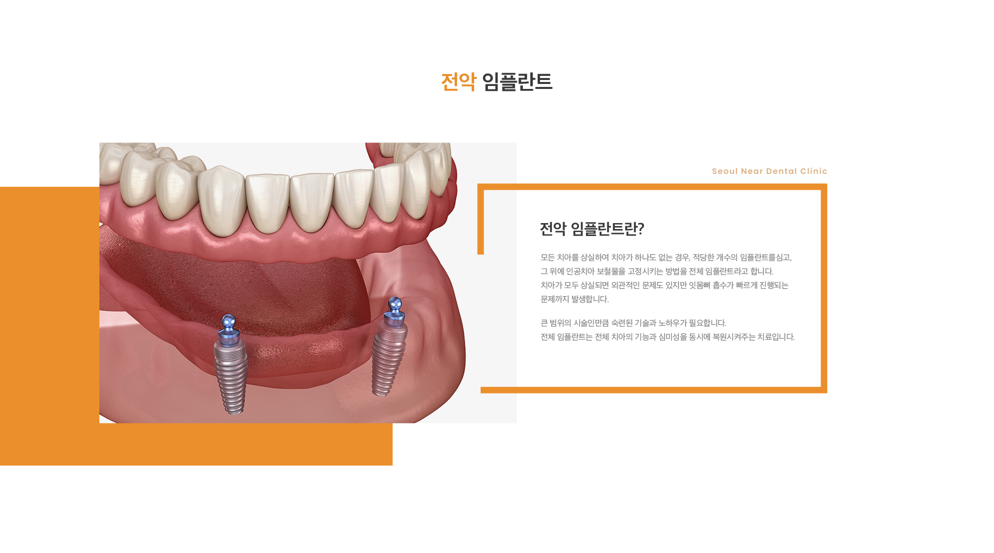 전악 임플란트란? 모든 치아를 상실하여 치아가 하나도 없는 경우, 적당한 개수의 임플란트를심고, 그 위에 인공치아 보철물을 고정시키는 방법을 전체 임플란트라고 합니다. 치아가 모두 상실되면 외관적인 문제도 있지만 잇몸뼈 흡수가 빠르게 진행되는 문제까지 발생합니다. 큰 범위의 시술인만큼 숙련된 기술과 노하우가 필요합니다. 전체 임플란트는 전체 치아의 기능과 심미성을 동시에 복원시켜주는 치료입니다. 