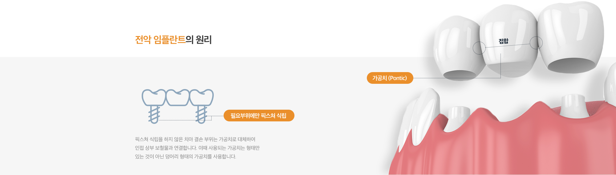 전악 임플란트의 원리 : 픽스쳐 식립을 하지 않은 치아 결손 부위는 가공치로 대체하여 인접 상부 보철물과 연결합니다. 이때 사용되는 가공치는 형태만 있는 것이 아닌 덩어리 형태의 가공치를 사용합니다.