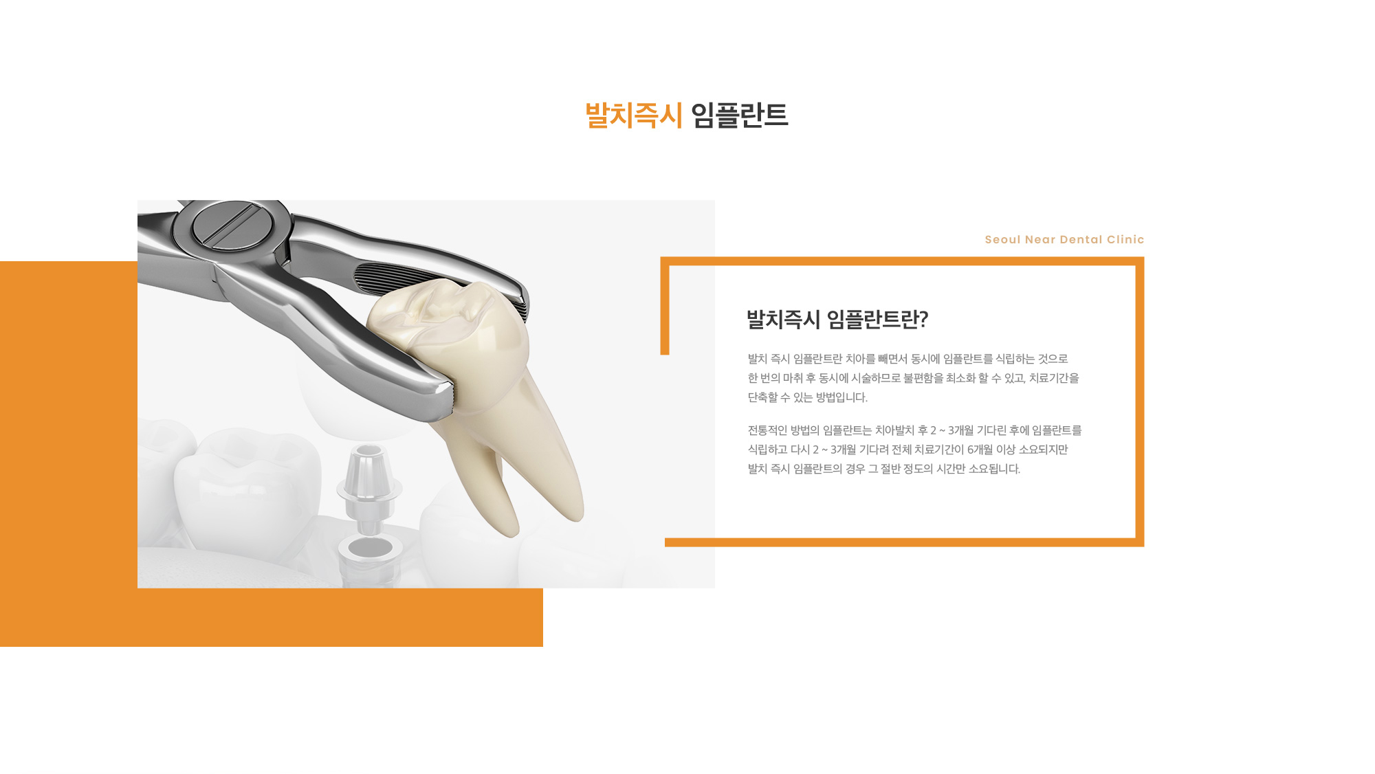 발치즉시 임플란트란? 발치 즉시 임플란트란 치아를 빼면서 동시에 임플란트를 식립하는 것으로 한 번의 마취 후 동시에 시술하므로 불편함을 최소화 할 수 있고, 치료기간을 단축할 수 있는 방법입니다. 전통적인 방법의 임플란트는 치아발치 후 2 ~ 3개월 기다린 후에 임플란트를 식립하고 다시 2 ~ 3개월 기다려 전체 치료기간이 6개월 이상 소요되지만 발치 즉시 임플란트의 경우 그 절반 정도의 시간만 소요됩니다.
