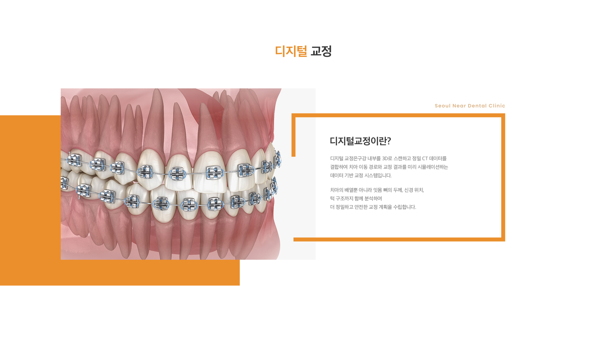 디지털교정이란? 디지털 교정은구강 내부를 3D로 스캔하고 정밀 CT 데이터를 결합하여 치아 이동 경로와 교정 결과를 미리 시뮬레이션하는 데이터 기반 교정 시스템입니다. 치아의 배열뿐 아니라 잇몸 뼈의 두께, 신경 위치, 턱 구조까지 함께 분석하여 더 정밀하고 안전한 교정 계획을 수립합니다.