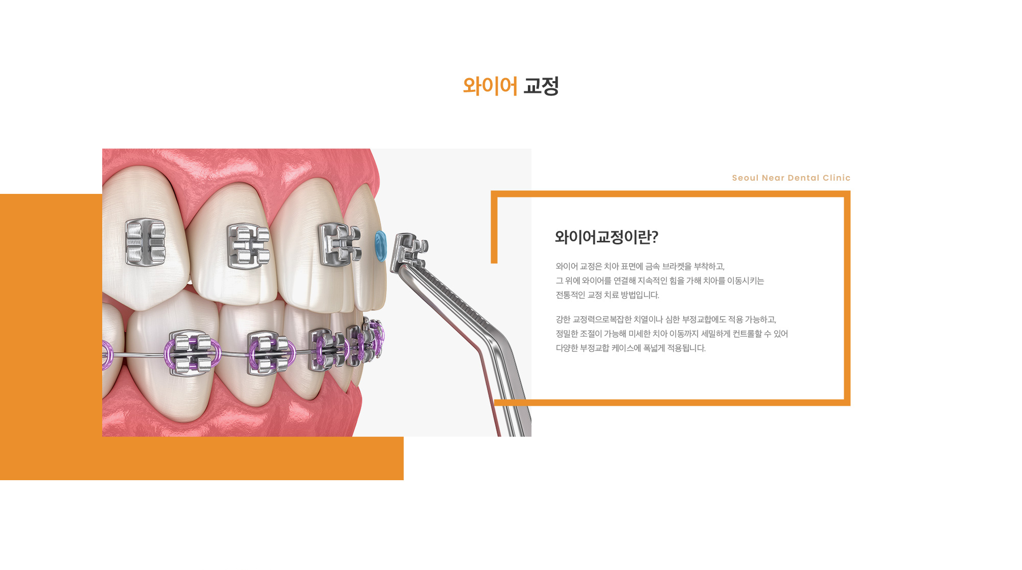 와이어교정이란? 와이어 교정은 치아 표면에 금속 브라켓을 부착하고, 그 위에 와이어를 연결해 지속적인 힘을 가해 치아를 이동시키는 전통적인 교정 치료 방법입니다. 강한 교정력으로복잡한 치열이나 심한 부정교합에도 적용 가능하고, 정밀한 조절이 가능해 미세한 치아 이동까지 세밀하게 컨트롤할 수 있어 다양한 부정교합 케이스에 폭넓게 적용됩니다.