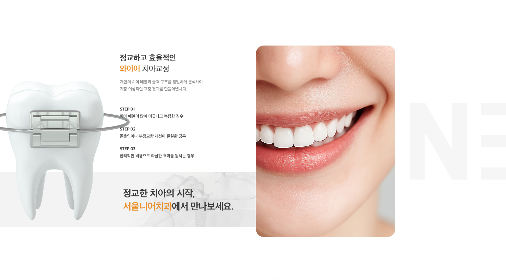 정교하고 효율적인 와이어 치아교정 개인의 치아 배열과 골격 구조를 정밀하게 분석하여, 가장 이상적인 교정 결과를 만들어냅니다.